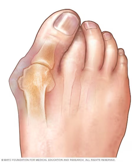 Do Barefoot Shoes Help With Bunions? What to Know Before You Switch